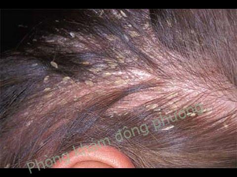 nguyên nhân gây bệnh nấm da đầu