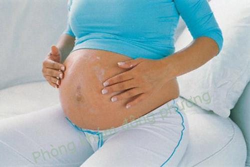 Bị chàm khi mang thai không nên xem nhẹ