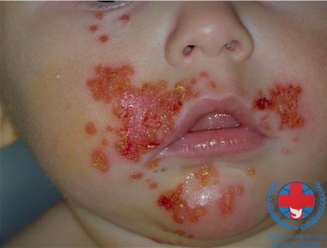 Viêm da bội nhiễm ở trẻ em làm thế nào để trị bệnh dứt điểm