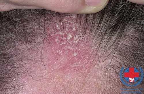 Bệnh chàm da đầu do dị ứng