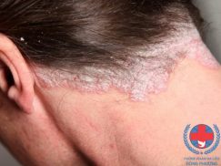 Bệnh chàm da đầu và những điều cần biết