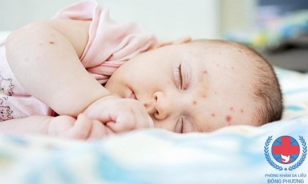Biểu hiện của bệnh chàm da ở trẻ sở sinh là nổi mụn nước