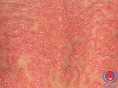 Tìm hiểu về bệnh vảy nến thể đỏ da