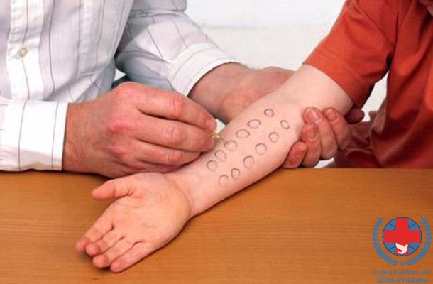 Phương pháp xét nghiệm dị ứng da phổ biến là test lẩy da