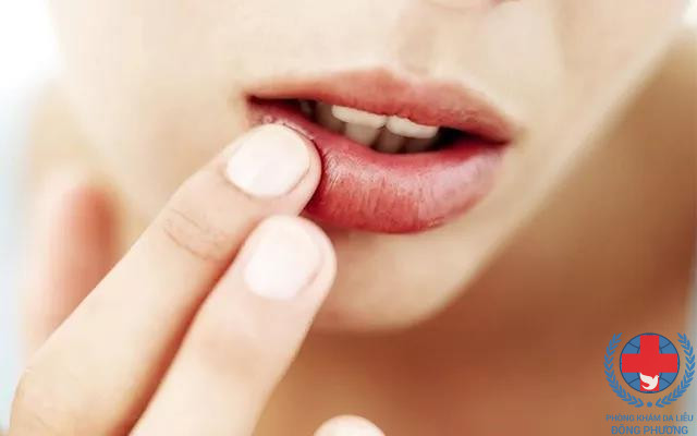 Bệnh ngứa môi – Phải làm gì cho hết ngứa đây ?