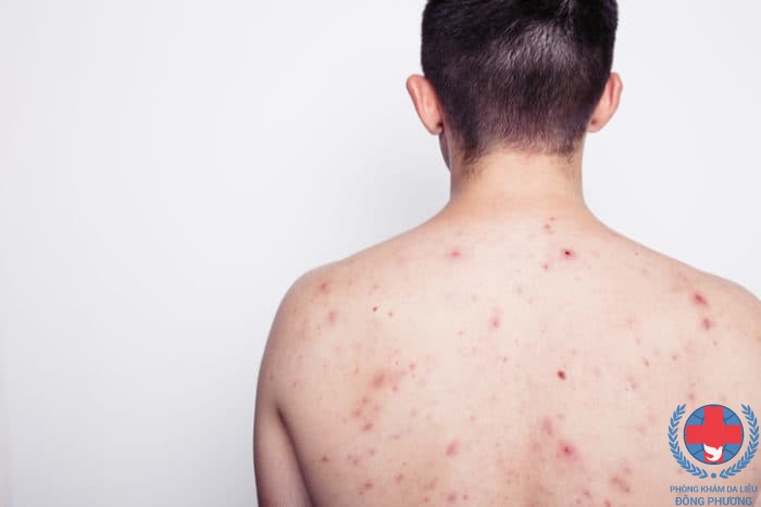 Bệnh nấm da có chữa được không ?