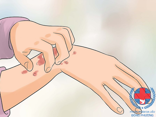 Dị ứng da tay – cách nhận biết và mẹo chữa cực nhanh