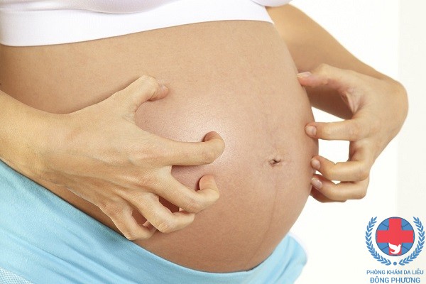 Mách mẹ bầu cách giảm ngứa thai kỳ vô cùng hiệu quả