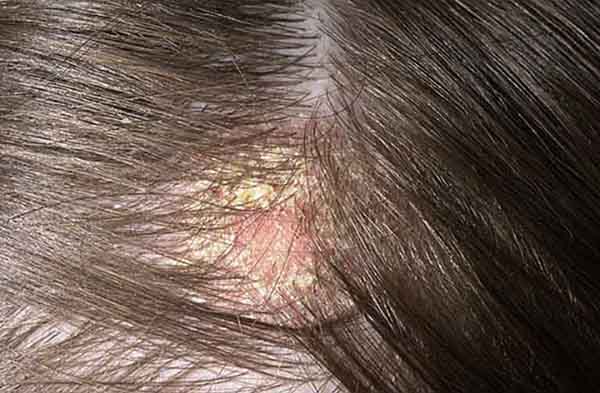 Bệnh nấm da đầu nguyên nhân do đâu?