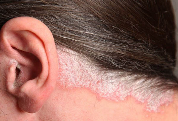 Biểu Hiện Bệnh Nấm Da đầu