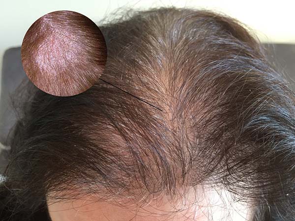 Triệu chứng bệnh nấm da đầu – Cách nhận diện