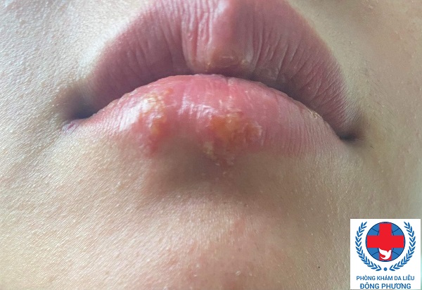 Bệnh herpes môi chữa bằng cách nào?